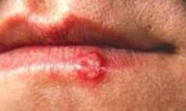 به کدام ضایعه پوستی توجه بیشتری کنیم؟ به کدام ضایعه پوستی توجه بیشتری کنیم؟